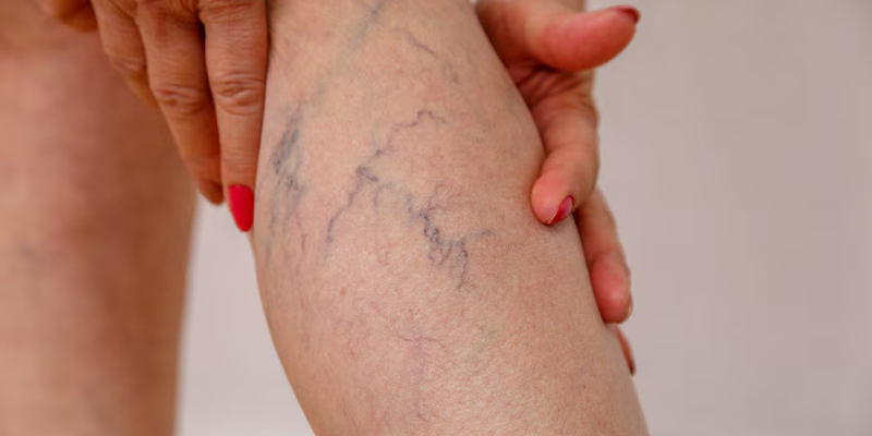 Varicose veins